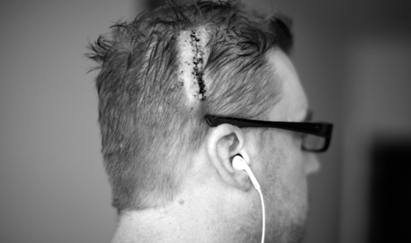 Man who just went through brain surgery. Photo Credit: Kevin Stanchfield / Flickr